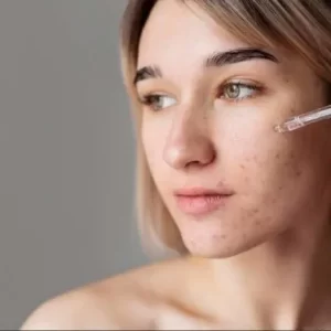10 Kandungan Skincare untuk Kulit Berjerawat yang Aman